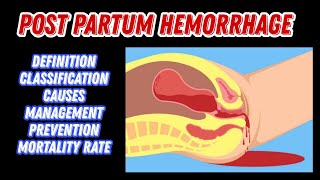 Post Partum Hemorrhage  Causes Classification Treatment  PPH  MisMedicine [upl. by Damha]