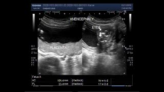 Ultrasound Video showing Anencephaly with a pregnancy of about 17 weeks [upl. by Ragse]