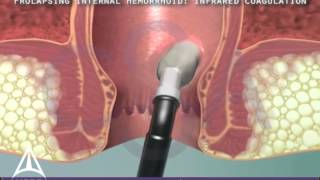 Infrared Coagulation Therapy for Hemorrhoids  3D Medical Animation [upl. by Goodson]