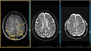 Polyneuropathy Symptoms Diagnosis and Advanced Treatment Options [upl. by Maurey]