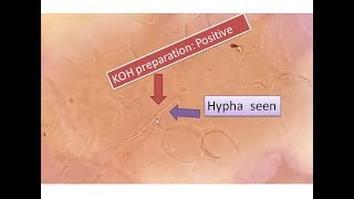 KOH positive  Fungal elements seen  Sputum  hyphae [upl. by Adlin86]