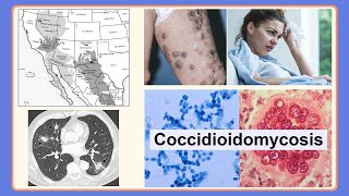 coccidioidomycosis [upl. by Nasho]