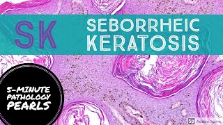 Seborrheic Keratosis 5Minute Pathology Pearls [upl. by Coniah]