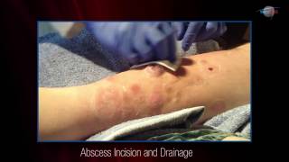 WCW Abscess Incision and Drainage [upl. by Peugia]