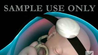 Fetal Distress Ultrasound and Heart Monitor [upl. by Pollerd798]