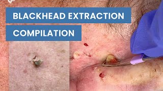 Extraction Satisfaction Blackhead Removal  CONTOUR DERMATOLOGY [upl. by Anived]