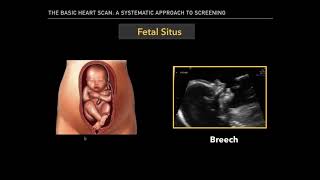 The Basic Fetal Heart Scan [upl. by Nosliw53]