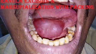 Ranula Excision amp Marsupialization with Packing [upl. by Notxap]