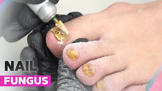 Onychomycosis  How to Deal with Nail Fungus [upl. by Iralav]