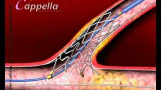 Stent insertion [upl. by Pedaiah]