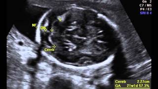 Fetal Anatomic Survey [upl. by Peterus28]