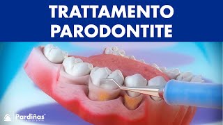 Trattamento parodontite – Curettage e sondaggio parodontale © [upl. by Lindsley979]