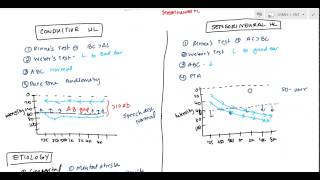 Conductive and Sensorineural Hearing Loss Deafness for USMLE [upl. by Platus]