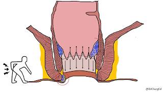 Hemorrhoids [upl. by Gaston]