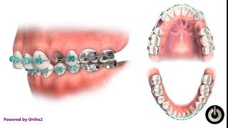 Upper First Premolar Extraction  Dental Braces  Temecula Valley CA [upl. by Neetsirk]