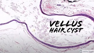 Vellus Hair Cyst 5Minute Pathology Pearls [upl. by Gage]