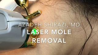 Laser Mole Removal [upl. by Oremodlab]