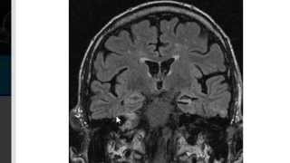 MRI in Epilepsy [upl. by Vasileior]