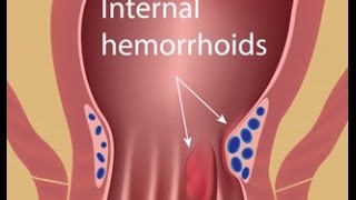 Hemorrhoid Treatment with Colorectal Surgeon Dr Jennifer Lowney [upl. by Lekcim]