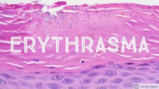 Erythrasma Corynebacterium minutissimum 5Minute Pathology Pearls Dermatopathology Dermatology [upl. by Dnomyaw477]