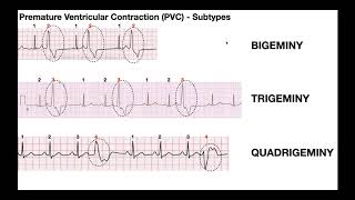 Atrial Fibrillation Overview  ECG types pathophysiology treatment complications [upl. by Retnuh363]