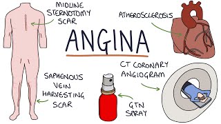 Understanding Angina Visual Explanation for Students [upl. by Regan]