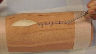 Suture Removal  simple interrupted [upl. by Adnawed]