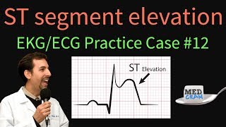 ST Elevation  EKG  ECG Interpretation Case 12 STEMI MI ACS [upl. by Lavona752]