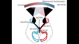 Bitemporal hemianopia [upl. by Vinaya]