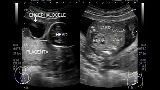 Advanced screening views of the fetal heart  Part 1  4chamber color and PW Doppler [upl. by Augusto]