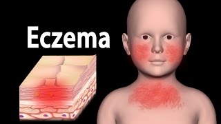 Eczema Animation [upl. by Blalock621]