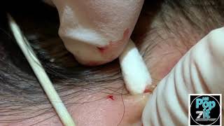 Your new favorite extraction video part 1 Blackheads whiteheads milia Over 20 minutes of pops [upl. by Alper]