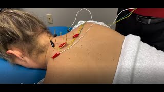 Dry Needling Demonstration and Explanation [upl. by Marduk92]