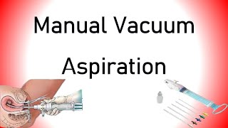 Manual Vacuum Aspiration MVA [upl. by Irolav]