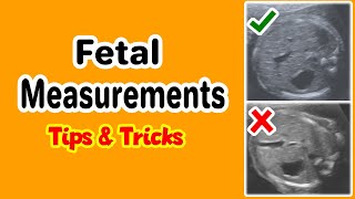 Fetal Measurements Tips and Tricks [upl. by Lanza]