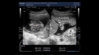 Ultrasound Video showing Anencephaly in a Pregnancy of about 20 weeks [upl. by Iggam]