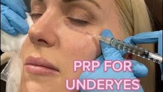 Undereye PRP Injections [upl. by Canfield]