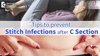 CSection Stitch InfectionsSigns Prevention amp Treatment  Immediate CareDrShashikala Hande of C9 [upl. by Lydell318]