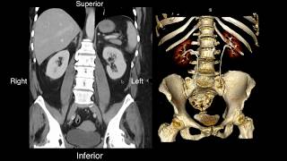 Normal Renal Anatomy [upl. by Nylecoj]