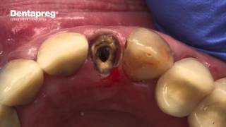 Emergency Repair of Loose Crown [upl. by Socher]