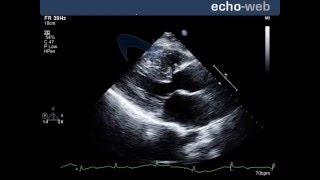 EKG Patterns  Premature Atrial amp Ventricular Contractions PACs amp PVCs [upl. by Rachele]