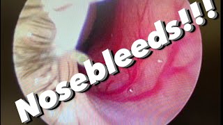 Nosebleeds epistaxis causes prevention treatments and more [upl. by Ingles]