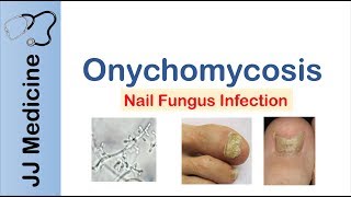 Onychomycosis  Nail Infection  Signs Symptoms Treatment [upl. by Fionna]