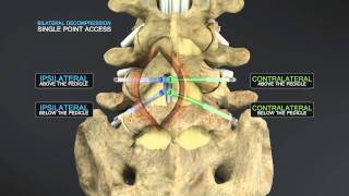 Medical Animation of Lumbar Stenosis Decompression [upl. by Victoir]