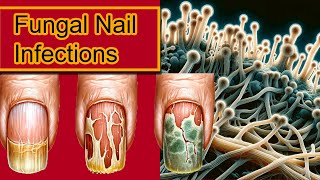 Understanding Onychomycosis Nail Fungal Infection Treatment [upl. by Hochman]