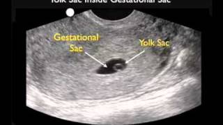 Ultrasound of normal early pregnancy [upl. by Aldus]