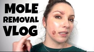 Mole Removal Vlog  Radiofrequency RF skin surgery before and after [upl. by Archibold]