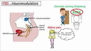 Can you get better from Interstitial CystitisBladder Pain Syndrome [upl. by Hudson]