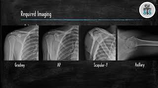 Proximal Humerus Fracture [upl. by Iliram870]