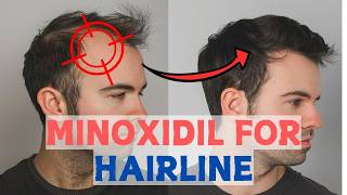 Minoxidil for Frontal Baldness  Restore Your Hairline [upl. by Nikral]